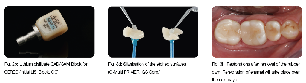 Process of restoration with lithium disilicate inlays